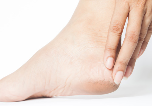 Heel Cracks and Medicines: Which Products Are More Effective?